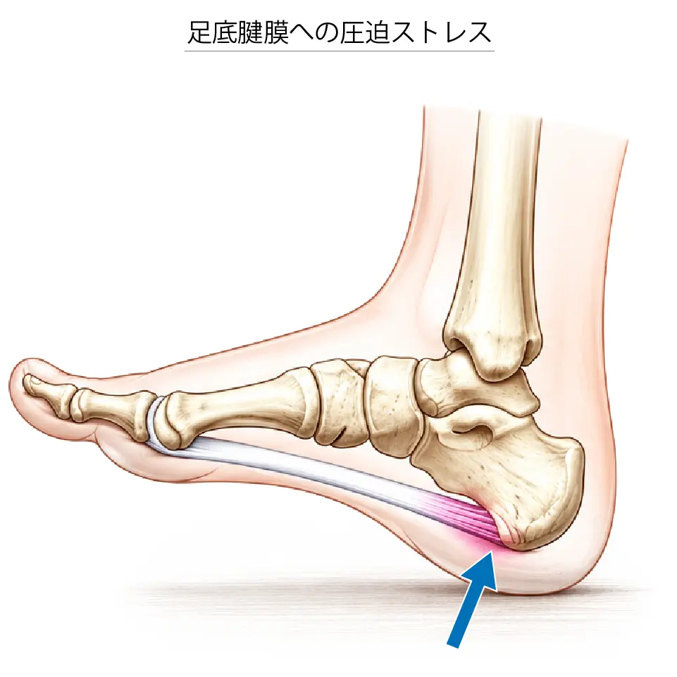 足底腱膜への圧迫ストレス