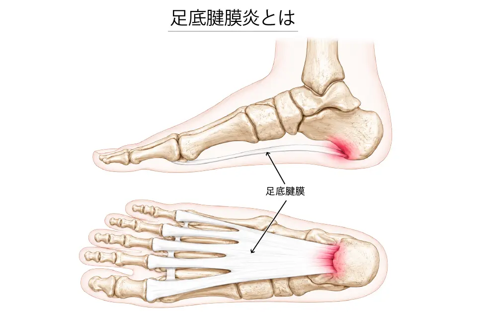 足底腱膜炎とは？