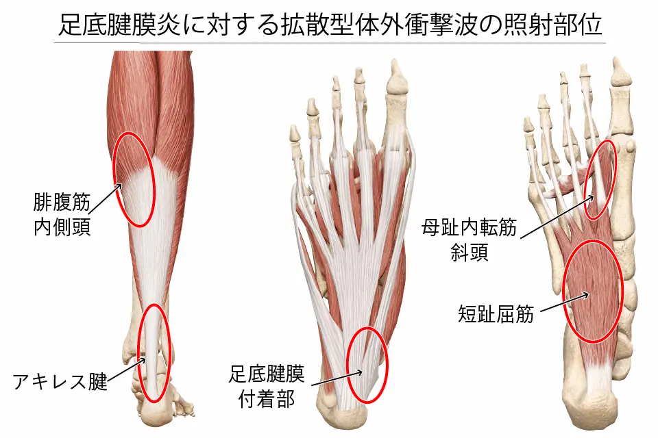足底腱膜炎に対する拡散型体外衝撃波の照射部位