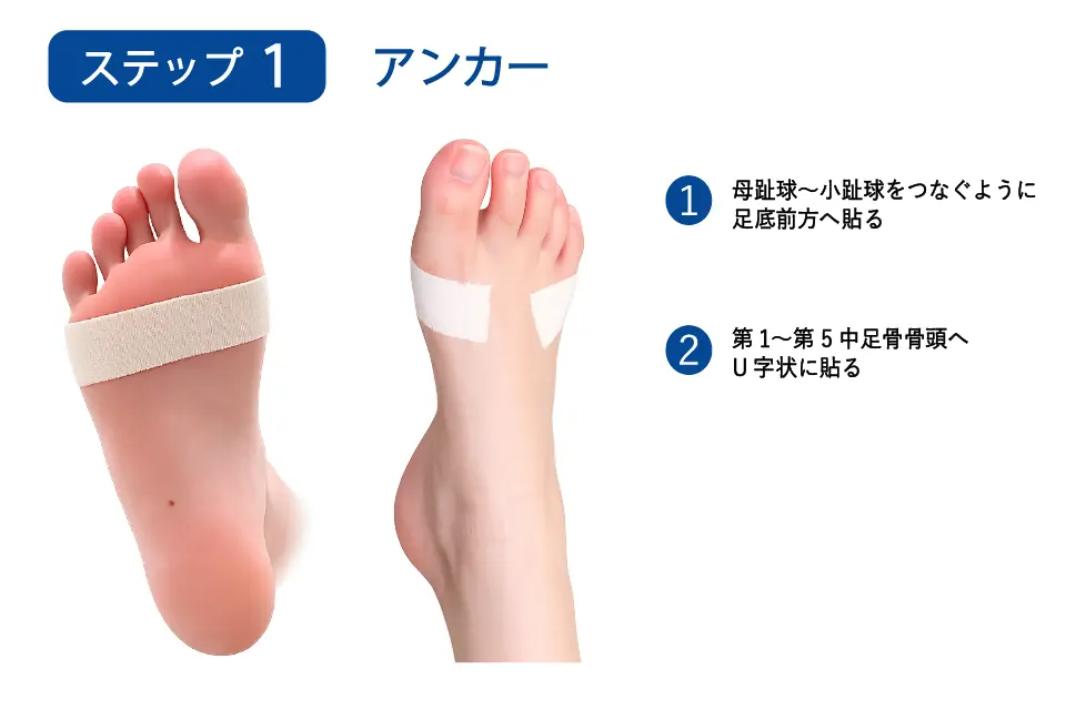 足底腱膜炎のテーピングステップ１