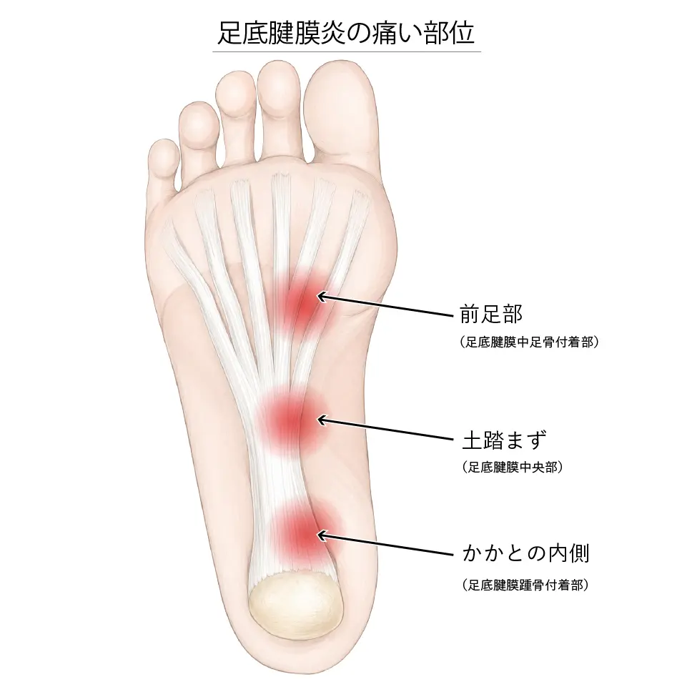 足底腱膜炎の痛い部位
