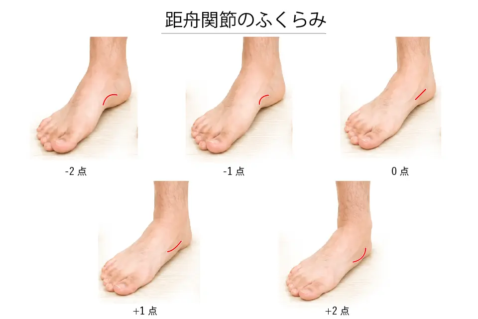 距舟関節のふくらみ