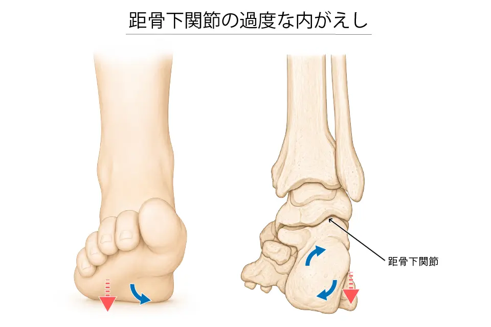 距骨下関節の過度な内がえし