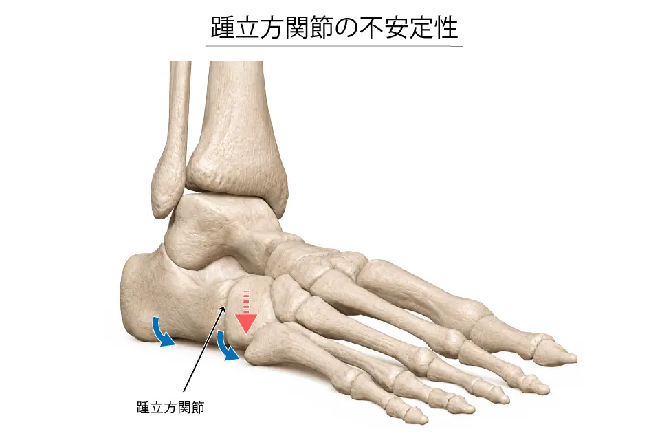 踵立方関節の不安定性