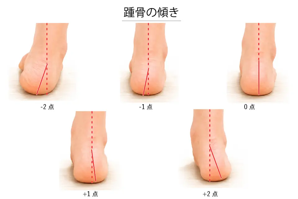 踵骨の傾き