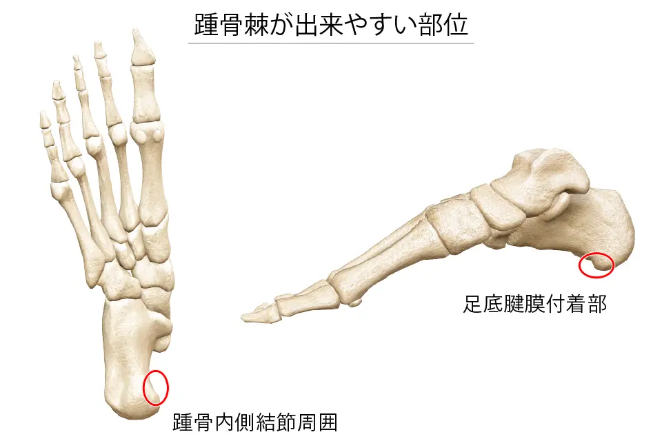 踵骨棘ができる部位