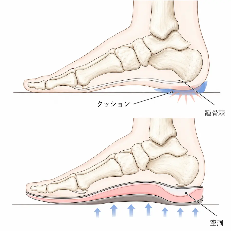踵骨棘に対するインソール (1)