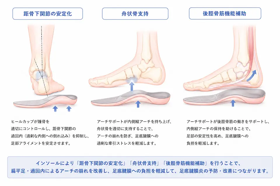 過回内・扁平足タイプの足底腱膜炎に対するインソール