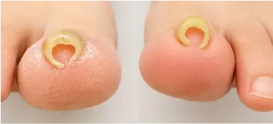 重度の巻き爪