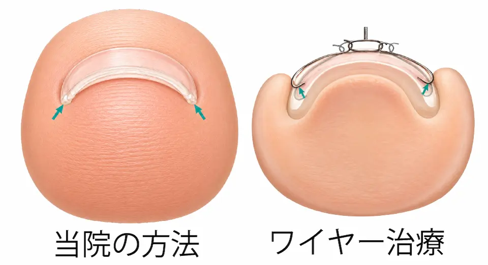 ワイヤー治療と当院の巻き爪矯正の方法の比較 (1)