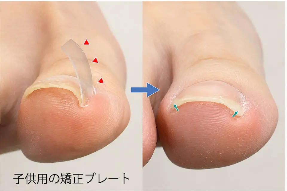 子供用の巻き爪矯正プレート
