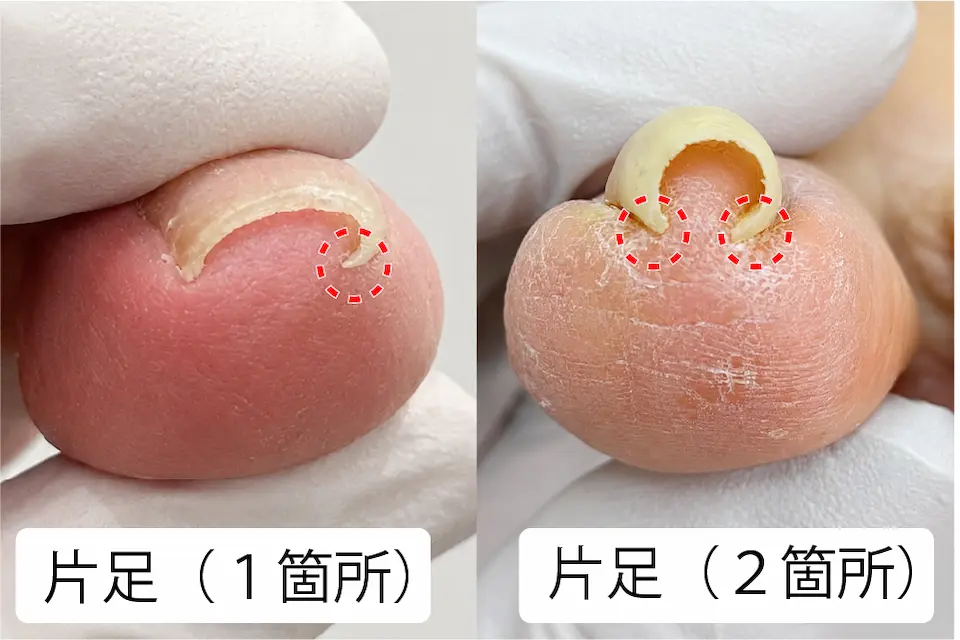 巻き爪片足1箇所・片足2箇所の違い 