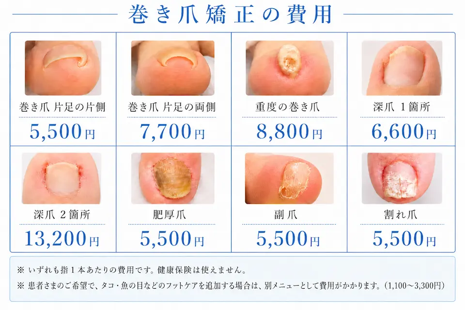 巻き爪矯正の費用
