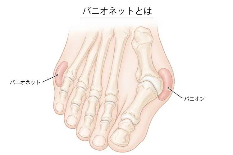 バニオネットとは
