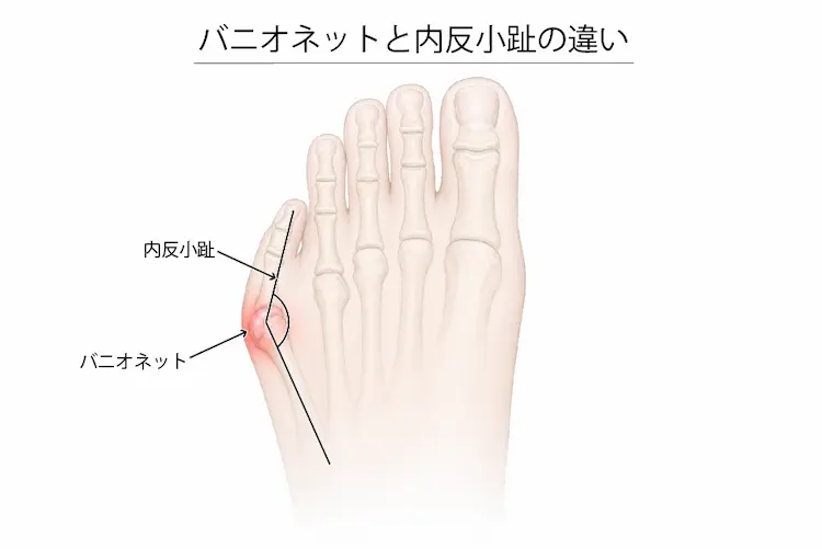 バニオネットと内反小趾の違い