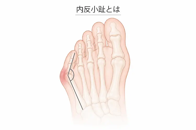 内反小趾とは