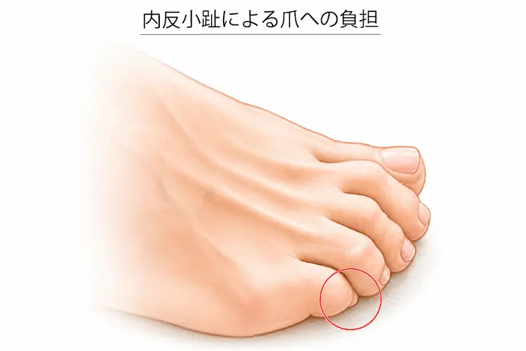 内反小趾による爪への負担