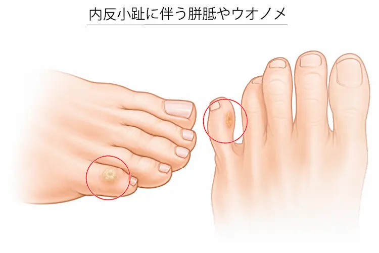内反小趾に伴う胼胝・ウオノメ