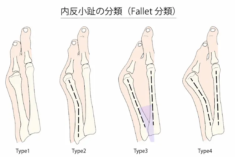 内反小趾の分類２