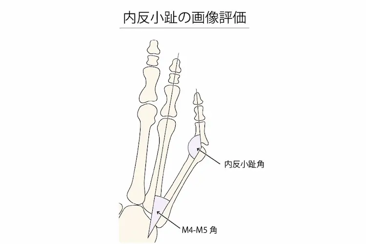 内反小趾の画像評価