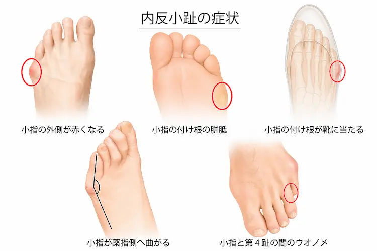 内反小趾の症状