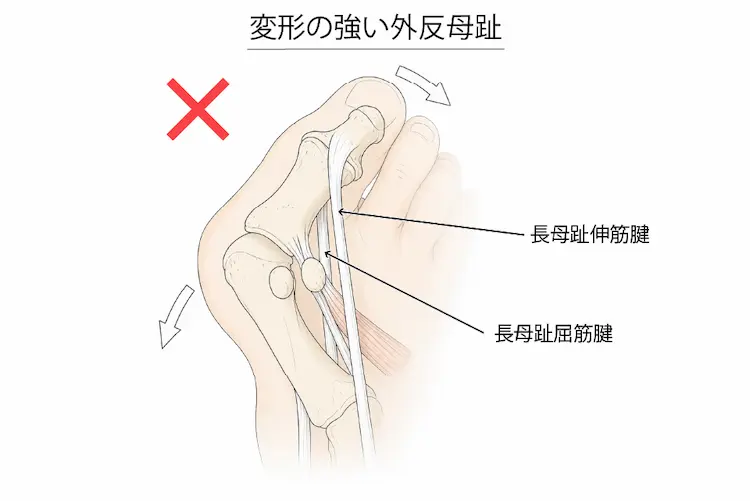 変形の強い外反母趾
