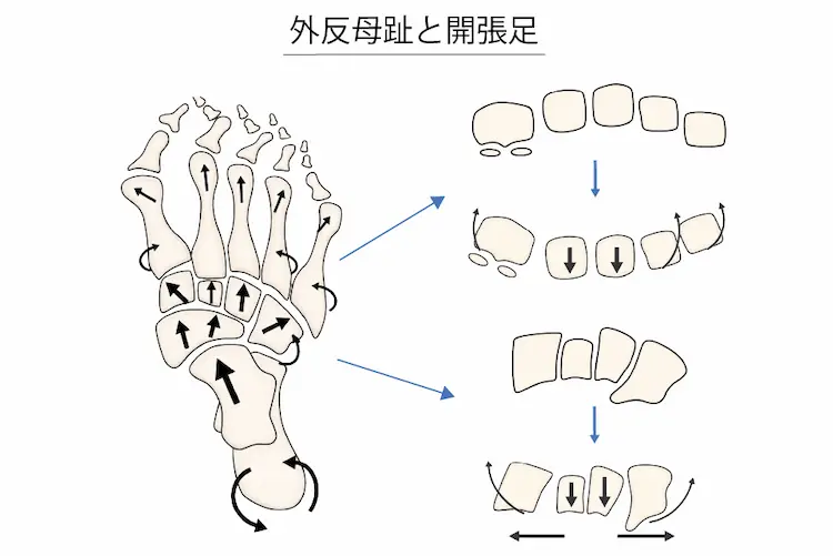 外反母趾と開張足