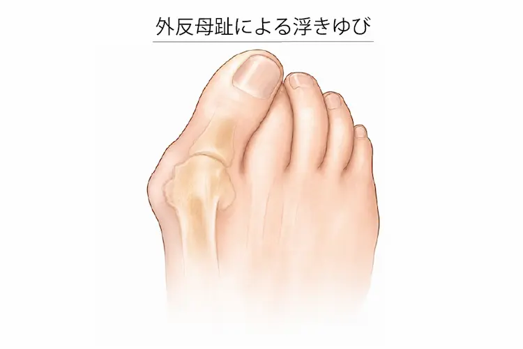 外反母趾による浮きゆび