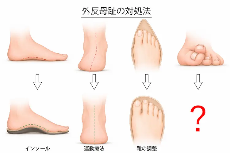 外反母趾の対処法