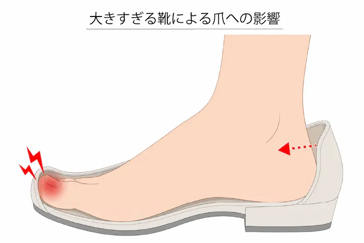 大きすぎる靴による巻き爪