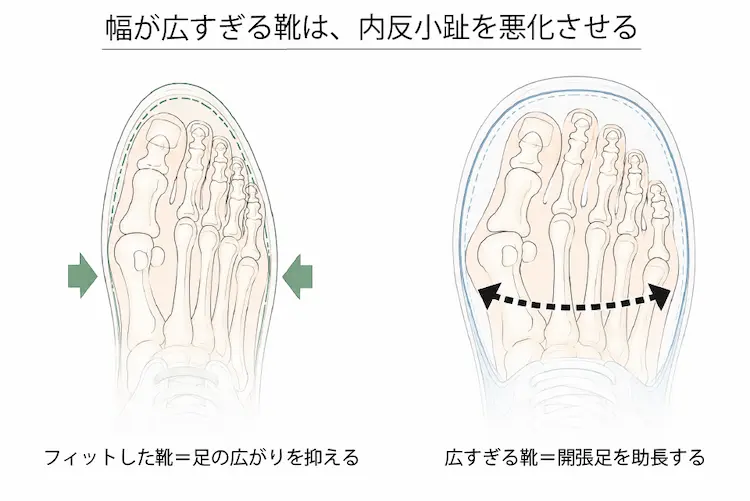 幅が広すぎる靴は、内反小趾を悪化させる