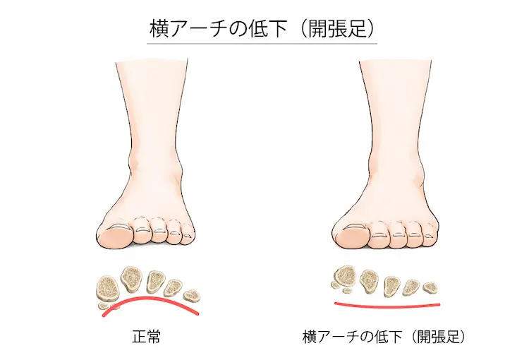横アーチの低下（開張足）２