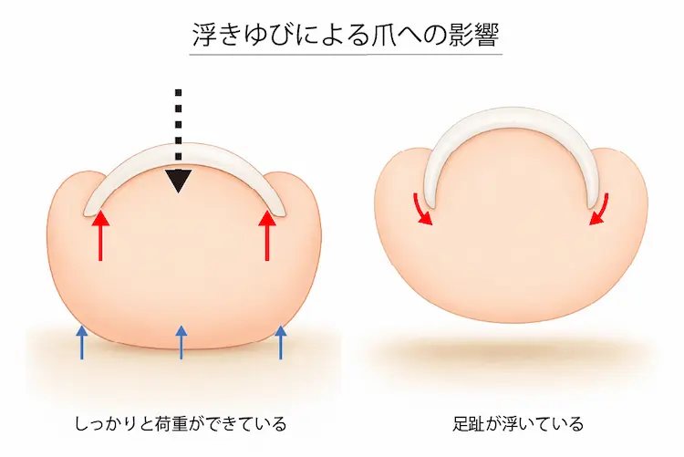 浮きゆびによる巻き爪