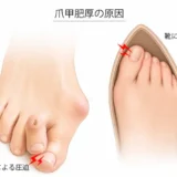 外反母趾で巻き爪になる理由