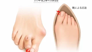 外反母趾で巻き爪になる理由
