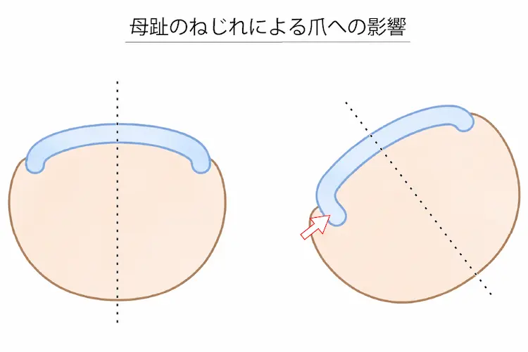 親指のねじれによる巻き爪