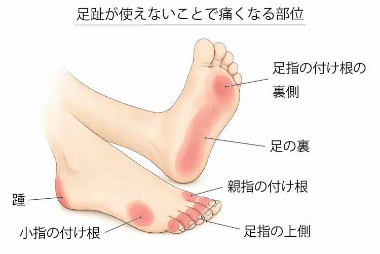 足趾が使えないことで痛くなる部位
