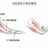 外反母趾とハンマートゥ｜足指の変形と痛みの関係