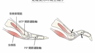 外反母趾とハンマートゥ｜足指の変形と痛みの関係