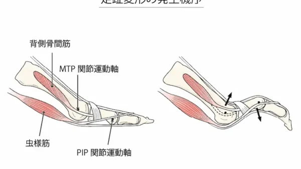 外反母趾とハンマートゥ｜足指の変形と痛みの関係