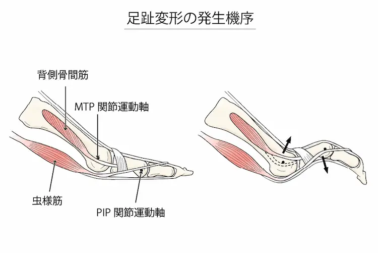 足趾変形の発生機序