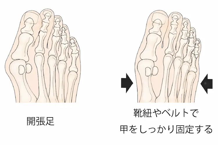 関節がやわらかい人の外反母趾で注意すること