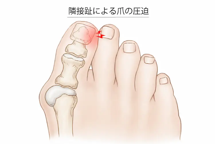 隣接趾による爪の圧迫