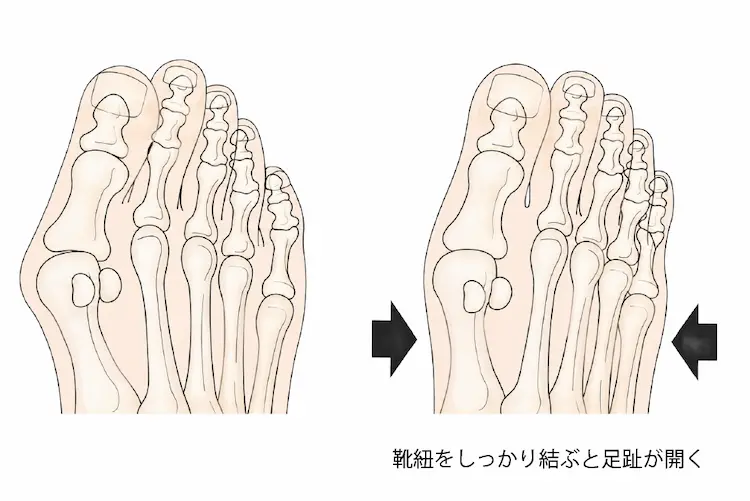 靴紐と外反母趾の関係