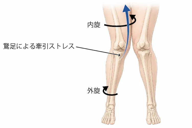 Knee inすると大腿骨が内旋、脛骨が外旋し鵞足筋による牽引ストレスが加わる説明をしたイラスト