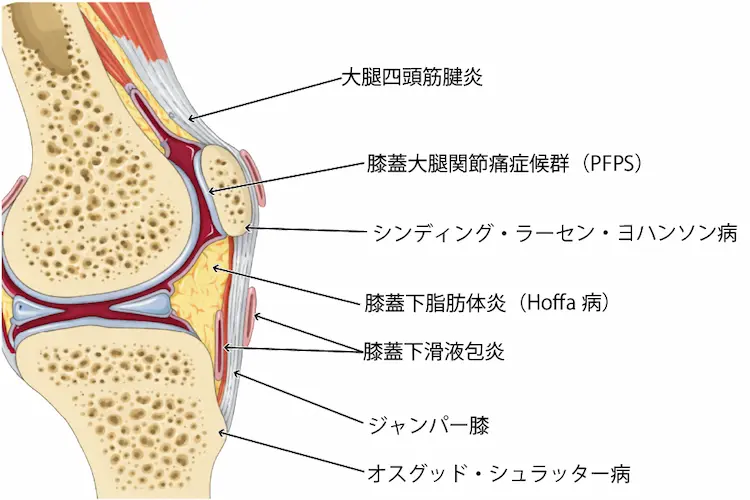 オスグッド病に似た疾患 (1)