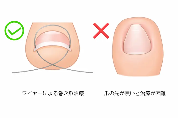ワイヤー治療は深爪だと治療できない