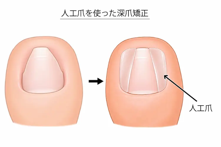 人工爪を使った深爪矯正