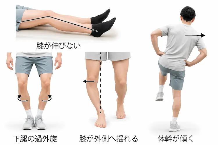 変形性膝関節症による鵞足炎の原因として膝の伸びが悪い、歩行中に膝が左右へ揺れる、下腿の回旋が大きい、体幹が左右へ傾く様子を説明したイラスト
