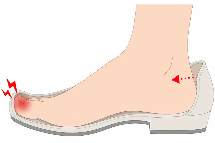 大きすぎる靴の中で足が前滑りして爪にダメージを与えている様子を説明したイラスト